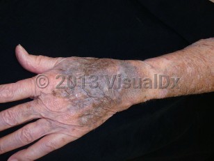Clinical image of Amiodarone drug-induced pigmentation - imageId=6646942. Click to open in gallery.  caption: 'Deep blue and somewhat violaceous patches on the dorsal hand, and brown discoloration on the forearm, developing secondary to medication.'