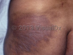Clinical image of Paraffinoma - imageId=6716892. Click to open in gallery.  caption: 'Reddish-brown and violaceous plaques on the buttock.'