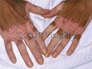 Clinical image of Chemical leukoderma - imageId=6717440. Click to open in gallery.  caption: 'Depigmented patches with a pinkish hue on the dorsal hands and fingers, secondary to a phenolic detergent. Note the confetti macules at the proximal patch edges.'