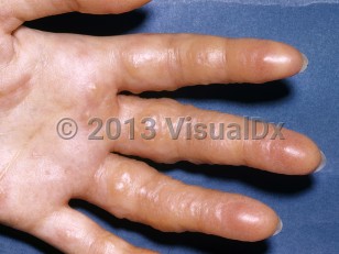 Clinical image of Vesicant exposure - imageId=6734211. Click to open in gallery.  caption: 'Numerous discrete and confluent vesicles and bullae on the fingers and palm, secondary to contact with nitrogen mustard.'