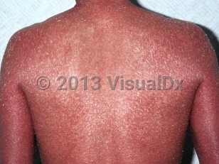 Clinical image of Congenital nonbullous ichthyosiform erythroderma - imageId=6750272. Click to open in gallery.  caption: 'Erythroderma secondary to non-bullous ichthyosiform erythroderma, showing diffuse deep red erythema and scaling on the back and arms.'
