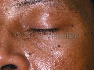 Clinical image of Dermatosis papulosa nigra - imageId=67656. Click to open in gallery.  caption: 'Scattered dark brown, stuck-on papules on the cheek and around the eye.'