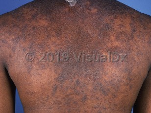 Clinical image of Infundibulofolliculitis - imageId=677237. Click to open in gallery.  caption: 'Multiple pink and dark brown follicular papules and background brown, scaly plaques on the back.'