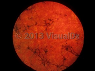 Clinical image of Usher syndrome - imageId=6773539. Click to open in gallery.  caption: 'Retinitis pigmentosa appearing as pigmentary clumping into a bony spicule formation, with severe attenuation of the retinal vessels.'