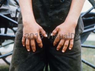 Clinical image of Weill-Marchesani syndrome - imageId=6773916. Click to open in gallery.  caption: '"Stubby," short fingers.'