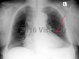 Imaging Studies image of Pericarditis - imageId=6789416. Click to open in gallery.  caption: '<span>Frontal view from chest xray demonstrating cardiomegaly in a patient with a history of pericardits.</span>'