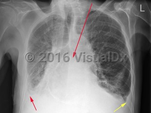 Imaging Studies image of Congestive heart failure - imageId=6789440. Click to open in gallery.  caption: 'PA chest xray demonstrating interstitial pulmonary edema with linear opacities throughout both lungs, peribronchial cuffing, and bilateral small pleural effusions, right, (small red arrow), and left, (small yellow arrow). In addition, there is a large hiatal hernia, (long red arrow).'