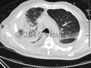 Imaging Studies image of Chlamydophila pneumoniae pneumonia - imageId=6838276. Click to open in gallery.  caption: '<span>Axial CT image shows extensive right upper lobe consolidation with air bronchograms. There are peripheral nodular ground glass opacities. Patient was positive for Chlamydophila pneumonia.</span>'