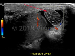 Imaging Studies image of Testicular torsion - imageId=6840062. Click to open in gallery.  caption: '<span>Transverse color Doppler image of superior aspect of left testicle, demonstrating torsion of epididymal appendage</span>.'