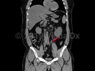 Imaging Studies image of Ureteral calculus - imageId=6841846. Click to open in gallery.  caption: '<span>Coronal image from unenhanced CT scan of abdomen and pelvis with left ureteral calculus in 47 year old male.</span>'