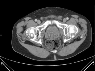 Imaging Studies image of Benign prostatic hyperplasia - imageId=6843804. Click to open in gallery.  caption: '<span>Axial CT image demonstrates enlarged prostate in this patient with known BPH. </span>'