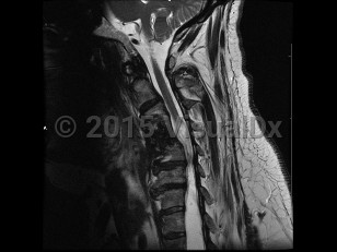Imaging Studies image of Syringomyelia - imageId=6844351. Click to open in gallery.  caption: '<span>Cystic space/collection within the spinal cord, secondary to trauma</span>.'
