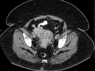 Imaging Studies image of Uterine fibroids - imageId=6844736. Click to open in gallery.  caption: '<span>Axial CT image demonstrates an exophytic fibroid arising from the uterus. </span>'