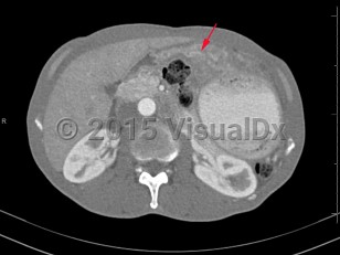 Imaging Studies image of Gastric cancer - imageId=6846464. Click to open in gallery.  caption: '<span>Axial CT image demonstrates  thickening and irregularity of the gastric antrum. Endoscopy findings  and biopsy were consistent with gastric carcinoma. </span>'