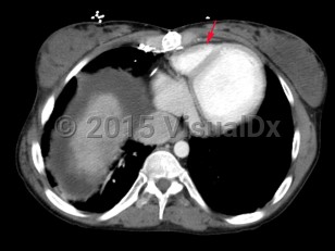 Imaging Studies image of Tricuspid atresia - imageId=6847804. Click to open in gallery.  caption: '<span>Axial CT image of the chest  demonstrates a hypoplastic right ventricle consistent with patient's history of congenital  tricuspid atresia.</span>'