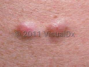 Clinical image of Cutaneous leiomyoma - imageId=687413. Click to open in gallery.  caption: 'A close-up of smooth, pink papules.'