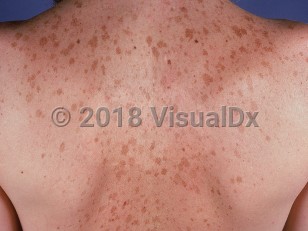 Clinical image of Solar lentigo - imageId=689350. Click to open in gallery.  caption: 'Many large tan macules on the back.'