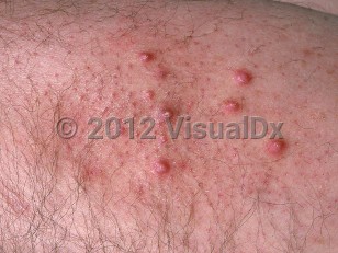 Clinical image of Kyrle disease - imageId=690314. Click to open in gallery.  caption: 'A close-up of several hyperkeratotic, deep pink papules, some with a prominent whitish portion centrally.'