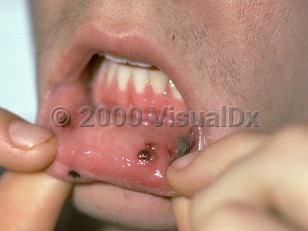 Clinical image of Oral leukemic infiltration - imageId=69176. Click to open in gallery. 