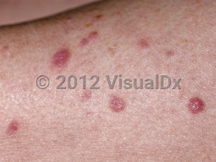 Clinical image of Leukemia cutis - imageId=69197. Click to open in gallery.  caption: 'A close-up of smooth deep red papules.'