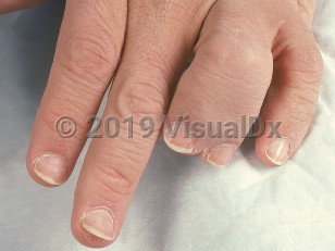 Clinical image of Laurence-Moon syndrome - imageId=694592. Click to open in gallery.  caption: 'Syndactyly and brachydactyly.'