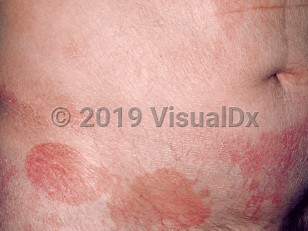 Clinical image of Cutaneous T-cell lymphoma - imageId=70243. Click to open in gallery.  caption: 'Patch stage mycosis fungoides, showing thin scaly erythematous and brown plaques on the lower abdomen.'