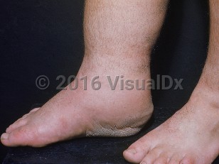 Clinical image of Congenital lymphedema - imageId=703804. Click to open in gallery.  caption: 'Swelling of the right leg and foot with secondary verrucous changes (elephantiasis nostras verrucosa) on the sole.'