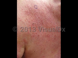 Clinical image of Chronic eczematous eruptions of the aged - imageId=7087103. Click to open in gallery.  caption: 'Scaly and crusted erythematous plaques on the upper back.'