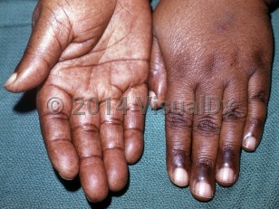 Clinical image of Vitamin B12 deficiency - imageId=7114227. Click to open in gallery.  caption: 'Hyperpigmented palmar macules and prominent pigmentation in palmar creases and over interphalangeal joints.'