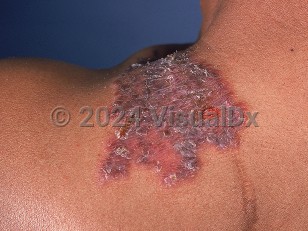 Clinical image of Cutaneous tuberculosis - imageId=716018. Click to open in gallery.  caption: 'Lupus vulgaris, showing a pink and violaceous, scaly and crusted plaque on the shoulder.'