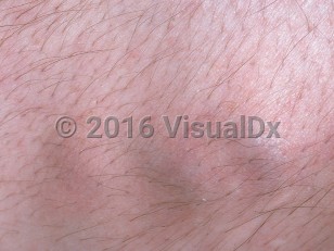 Clinical image of Mondor syndrome - imageId=729087. Click to open in gallery. 
