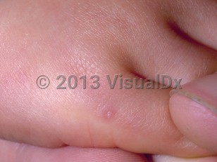 Clinical image of Infantile myofibromatosis - imageId=72924. Click to open in gallery.  caption: 'A tiny pink papule with scant overlying scale on the finger.'