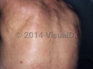 Clinical image of Familial cutaneous collagenoma syndrome - imageId=7302815. Click to open in gallery. 