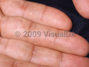 Clinical image of Angiokeratoma of Mibelli - imageId=73068. Click to open in gallery.  caption: 'Tiny maroon macules and papules on the fingers.'