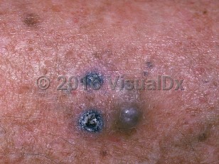 Clinical image of Metastatic cutaneous melanoma - imageId=731135. Click to open in gallery.  caption: 'A close-up of a cluster of black and deep gray papules, and background sun-damaged skin.'