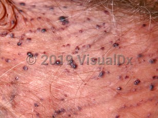 Clinical image of Fordyce angiokeratoma of scrotum - imageId=73207. Click to open in gallery.  caption: 'A close-up of multiple maroon and dark purple scrotal papules of varying sizes.'