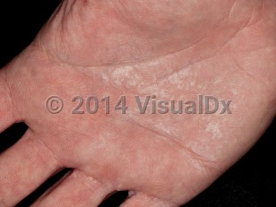 Clinical image of Aquagenic wrinkling of the palms - imageId=7349462. Click to open in gallery.  caption: 'Accentuated palmar wrinkling with superimposed macerated scale, immediately after a 3 minute soak in water.'