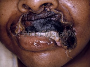 Clinical image of Noma - imageId=7395913. Click to open in gallery.  caption: 'An extensive eschar on the upper and lateral lip with loss of tissue around it.'