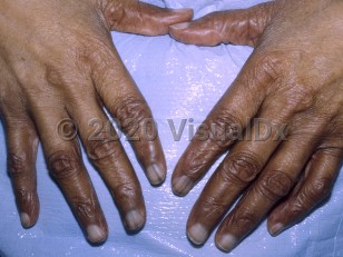 Clinical image of Pernicious anemia - imageId=7407746. Click to open in gallery.  caption: 'Diffuse brown pigmentation of the fingers.'