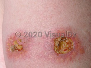 Clinical image of Necrobiotic xanthogranuloma - imageId=749279. Click to open in gallery.  caption: 'A close-up of ulcerated and crusted, yellowish and pink plaques, on the upper arm.'
