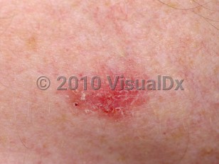 Clinical image of Superficial basal cell carcinoma - imageId=75190. Click to open in gallery.  caption: 'A close-up of a deep pink plaque with some overlying scale.'