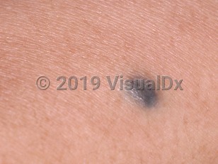 Clinical image of Blue nevus - imageId=75840. Click to open in gallery.  caption: 'A close-up of a smooth, violaceous papule.'