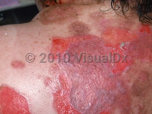 Clinical image of Pemphigus vulgaris - imageId=759613. Click to open in gallery.  caption: 'Large erosions, healing with a purplish color (re-epithelialization) and surrounding brown postinflammatory macules on the back.'