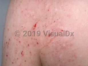 Clinical image of Pediculosis corporis - imageId=769280. Click to open in gallery.  caption: 'Numerous excoriated papules, some bleeding, on the upper arm and lateral back.'