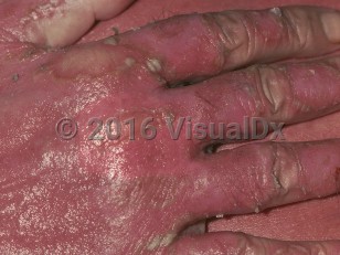 Clinical image of Erythrodermic psoriasis - imageId=784383. Click to open in gallery.  caption: 'Diffuse erythema and thick scales over the dorsal hand in a patient with erythrodermic psoriasis.'