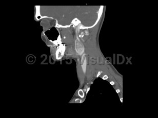 Imaging Studies image of Carotid body tumor - imageId=7872301. Click to open in gallery.  caption: '<span>Sagittal post-contrast CT image  demonstrates an enhancing mass in the carotid space, splaying the  internal and external carotid arteries. Findings are consistent with a  carotid body tumor.</span>'