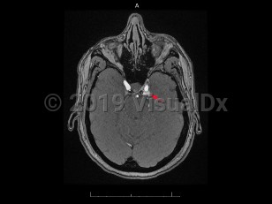 Imaging Studies image of Carotid-cavernous fistula - imageId=7872355. Click to open in gallery.  caption: '<span>Axial post-contrast MR image demonstrates abnormal opacification of the left cavernous sinus, consistent with  carotid-cavernous fistula.</span>'