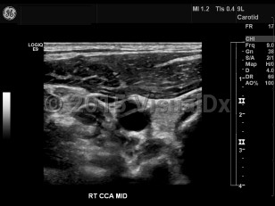 Imaging Studies image of Carotid artery dissection - imageId=7872495. Click to open in gallery.  caption: '<span>Common carotid artery dissection.   Grayscale ultrasound image demonstrates a luminal flap within the common  carotid artery. Dissection was confirmed by CT angiogram (not shown).</span>'