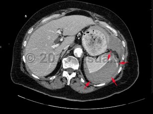 Imaging Studies image of Splenic rupture - imageId=7872924. Click to open in gallery.  caption: '<span>Axial CT image of the abdomen  demonstrates a large subcapsular splenic hematoma, with evidence of  active contrast extravasation and hemoperitoneum. Findings were  consistent with splenic rupture.</span>'