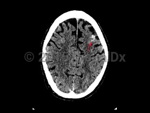 Imaging Studies image of Subarachnoid hemorrhage - imageId=7872963. Click to open in gallery.  caption: '<span>Axial CT image in a patient  with history of MVC, demonstrates a focal hyperdensity in the left  frontal lobe, consistent with subarachnoid hemorrhage.</span>'